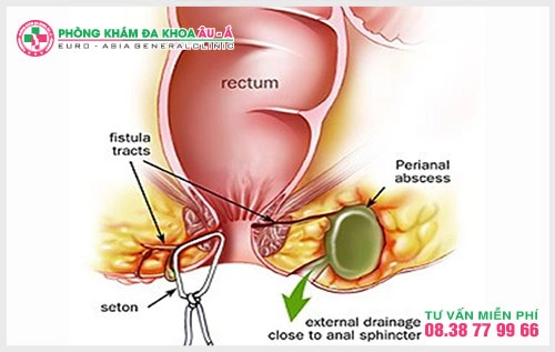 Đa Khoa Âu Á là một trong những địa chỉ y tế uy tín  tại TPHCM đã và đang áp dụng phương pháp chữa trị bệnh rò hậu môn chảy mủ hiệu quả  hiện nay đó là HCPT và PPH.