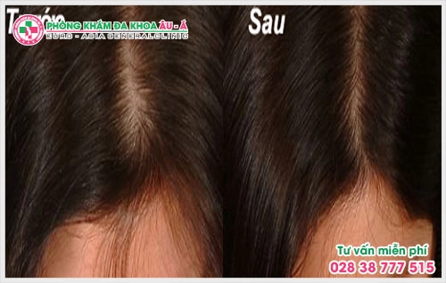 Chính vì vậy để cho quá trình điều trị được diễn ra suôn sẻ thì việc nhận biết các dấu hiệu bệnh rụng tóc là điều hết sức quan trọng