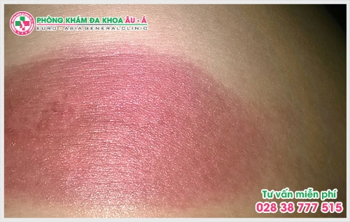 Bệnh chàm bìu ở nam giới là căn bệnh rất dễ tái phát nhiều lần và thường gây nên cảm giác ngứa ngáy, ảnh hưởng không nhỏ đến cuộc sống của người bệnh.