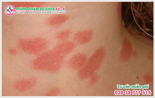 Nhiều người bệnh vẫn chưa đi khám vì còn lo lắng về chi phí xét nghiệm vảy nến hết bao nhiêu? Đây chính là điều mà rất nhiều người bệnh quan tâm.