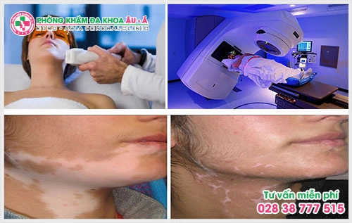 Chữa bệnh bạch biến ở đâu tốt 