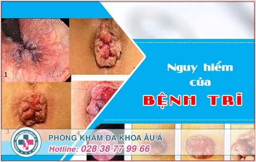 Với những tiêu chí đánh giá trên mà người bệnh không nên bỏ qua mà thay vào đó có thể đến ngay các địa chỉ chữa bệnh trĩ uy tín, chất lượng tại TPHCM để được điều trị kịp thời và dứt điểm.