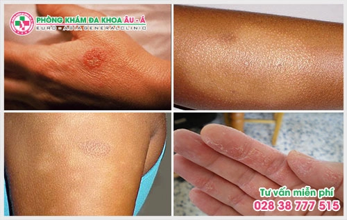 khi có các triệu chứng bệnh bệnh chàm người bệnh nên nhờ sự giúp đỡ của các bác sĩ da liễu để tránh những hậu quả nghiêm trọng về sau