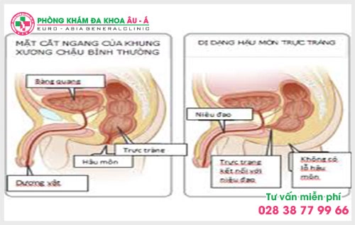 Chính vì thế mà rất nhiều người vẫn đang thắc mắc dị dạng hậu môn trực tràng có nguy hiểm không?