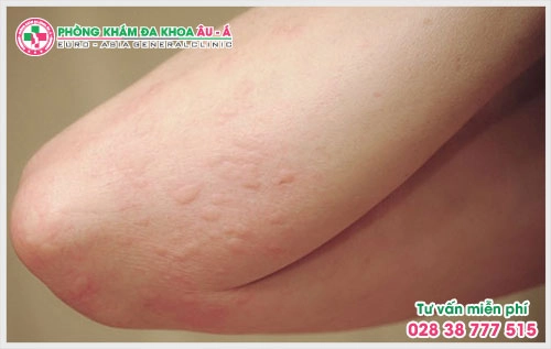 Việc lựa chọn địa chỉ chữa bệnh dị ứng da ở TPHCM là điều mà được nhiều người bệnh quan tâm  hiện nay, người bệnh luôn lo lắng không biết địa chỉ đó có uy tín.