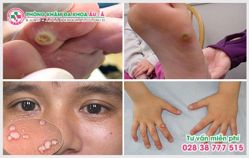 Chính vì thế mà chúng tôi khuyến cáo cháu Lê Hoa cũng như một số người bệnh khác nên suy nghĩ thật chính xác để tìm được địa chỉ chữa bệnh hạt cóc ở TPHCM để mang lại kết quả cao và không để bệnh tái phát.