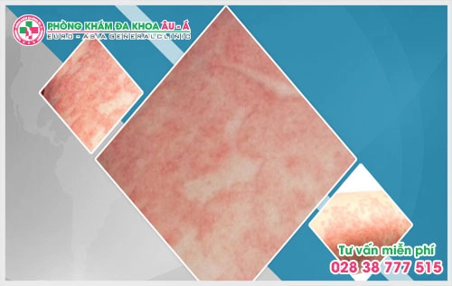 Song song với việc quan tâm phương pháp điều trị thì nhiều người tỏ ra khá lo lắng vì không biết khám bệnh chàm ở đâu là tốt  TP. HCM trong vô vàn những trung tâm da liễu được quảng cáo đầy rẫy trên mạng.