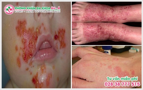 Để người bệnh có thể gởi gắm sức khỏe của mình tới những địa chỉ tin cậy thì người bệnh thường thắc mắc khám bệnh viêm da ở đâu tốt? đây chính là mối quan tâm  mà rất nhiều người đặt ra.