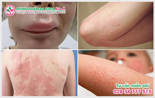 　　Để giúp người bệnh có thể lựa chọn đúng đắn trong việc khám dị ứng ở đâu tốt  tại TPHCM? Thì phòng khám đó phải đạt được những yêu cầu như: