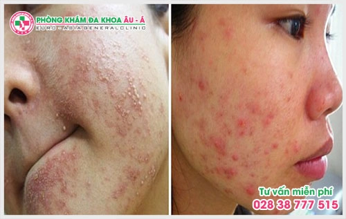  Người bệnh không nên chần chừ mà hãy tiến hành khám mụn trứng cá ở TPHCM càng sớm càng tốt ở phòng khám chuyên khoa Da để xác định đúng nguyên nhân và điều trị hiệu quả.