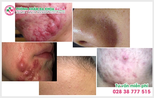  Người bệnh không nên chần chừ mà hãy tiến hành khám mụn trứng cá ở TPHCM càng sớm càng tốt ở phòng khám chuyên khoa Da để xác định đúng nguyên nhân và điều trị hiệu quả.