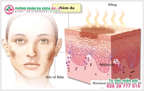 Nám da chính là nỗi ám ảnh của rất nhiều chị em, muốn đi khám nhưng không biết nên khám trị nám ở đâu tốt  tại TPHCM?