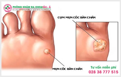 Không nên chủ quan khi bị mụn cóc ở chân