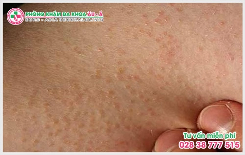 Vì thế, kinh nghiệm chữa dày sừng nang lông dưới đây sẽ giúp ích cho bạn trong việc ngăn ngừa cũng như có cách chữa bệnh dày sừng nang lông tốt .