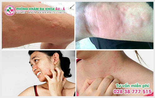 Có rất nhiều cách để điều trị bệnh mẩn ngứa, tùy theo từng nguyên nhân gây bệnh mà các chuyên gia da liễu sẽ sử dụng những phương pháp phù hợp