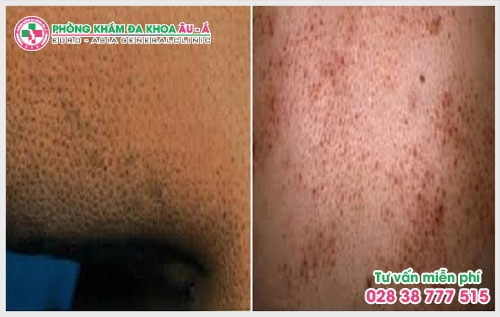 Một số mẹo chữa bệnh dày sừng nang lông dưới đây sẽ giúp ích cho bạn trong việc ngăn chặn, phòng tránh bệnh một cách hiệu quả và an toàn.