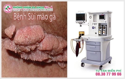 Mụn cóc sinh dục nam/nữ luôn là mối lo lắng được người bệnh quan tâm .