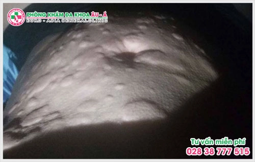 Các loại thuốc chữa bệnh ngứa khắp người  là thuốc bôi và thuốc uống, các loại này có tác dụng tiêu diệt các mầm móng gây bệnh