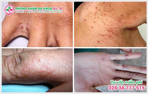 Trên bề mặt da xuất hiện những vết đỏ, nổi lên những mụn nước rất giống như những vết bỏng đây là triệu chứng bệnh ghẻ phỏng