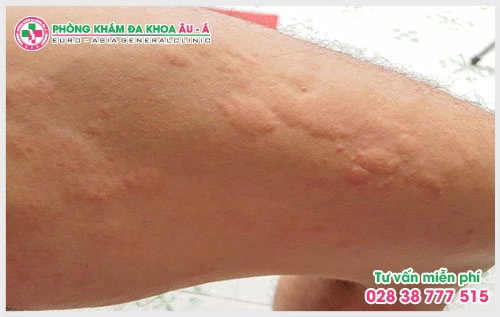 Thời tiết chuyển đột ngột từ nóng sang lạnh khiến cơ thể thích ứng không kịp cũng là một nguyên nhân gây ra bệnh mẩn ngứa nổi mề đay.