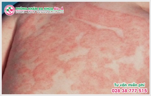 Tính chất công việc phải làm việc trong môi trường nhiễm bẩn, tiếp xúc với các hóa chất là một trong những nguyên nhân gây ra bệnh nấm da chàm hóa.