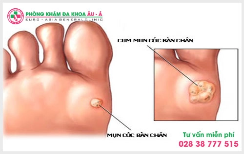 Nổi mụn cóc ở tay có nguy hiểm không?