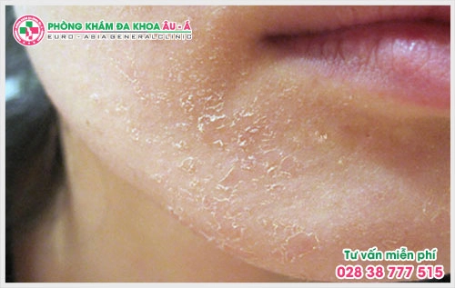 Bệnh vẩy nến trên mặt là một trong những bệnh ngoài da mà rất nhiều người đang thắc mắc tại sao bị bệnh vẩy nến trên da mặt để từ đó có hướng điều trị tốt hơn.