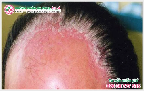 Bệnh á sừng, vẩy nến là một dạng viêm da có thể xuất hiện ở nhiều vị trí khác nhau trên cơ thể, bệnh vảy nến á sừng ở tay, ở đầu, chân.