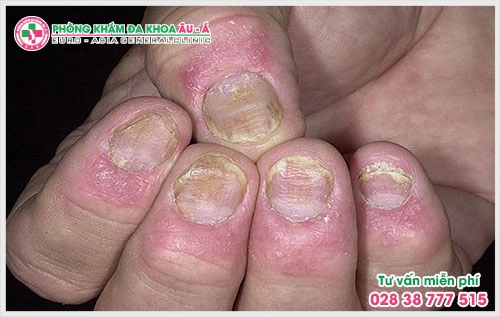 Bệnh vảy nến móng tay là căn bệnh da liễu thường gặp mà ai trong số chúng ta cũng có nguy cơ mắc phải khiến người bệnh cảm thấy mất tự tin, ngại giao tiếp với mọi người xung quanh.