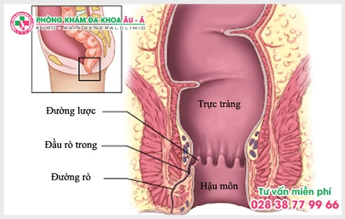 Vậy triệu chứng rò hậu môn như thế nào? sẽ được chúng tôi giải đáp qua bài viết dưới đây.