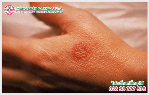 chuyên mục tự vấn bệnh chàm mà Phòng khám Da Liễu Âu Á chúng tôi sẽ giải đáp mọi thắc mắc qua bài viết dưới đây