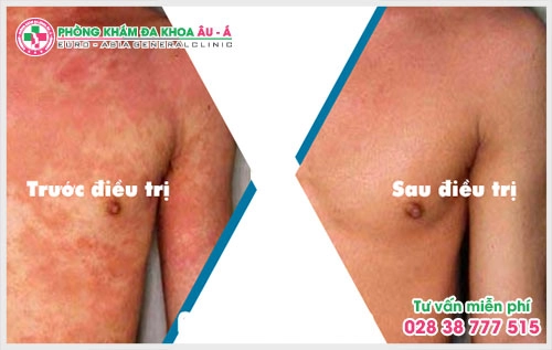 chuyên mục tự vấn bệnh chàm mà Phòng khám Da Liễu Âu Á chúng tôi sẽ giải đáp mọi thắc mắc qua bài viết dưới đây
