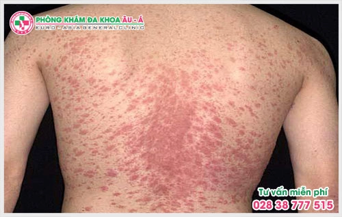 Vậy nguyên nhân, triệu chứng và cách điều trị của bệnh ra sao sẽ được các bác sĩ giải đáp qua chuyên mục tư vấn bệnh vảy nến của Da Liễu Âu Á