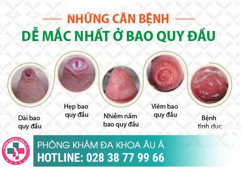 Dương vật cương cứng bị đau là gì?