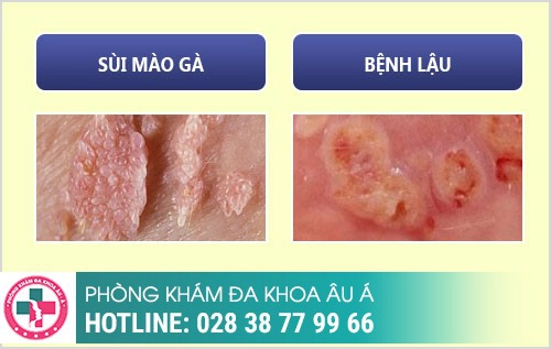 Bệnh dương vật