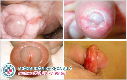 Sưng bao quy đầu dấu hiệu cảnh báo các bệnh ngoại khoa nam nguy hiểm