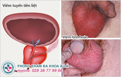 6 bệnh viêm nhiễm cơ quan sinh dục nam không nên bỏ qua