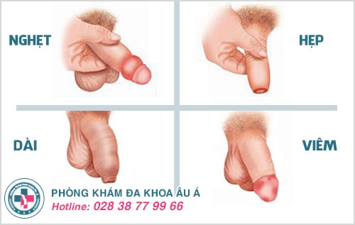 Thế Nào Là Cắt Bao Quy Đầu?