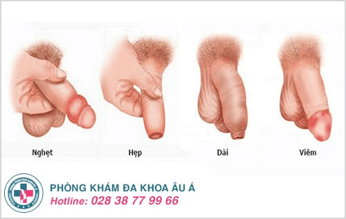 Những lợi ích cắt bao quy đầu đối với sức khỏe nam giới