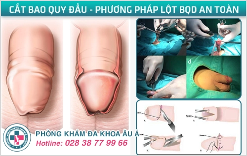 Những Biến Chứng Khi Tự Lột Bao Quy Đầu Tại Nhà