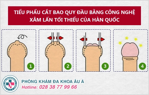 cắt bao quy đầu