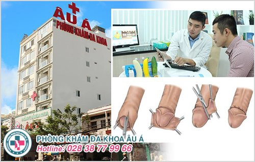 chi phí cắt bao quy đầu