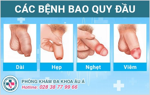 Sưng bao quy đầu dấu hiệu cảnh báo các bệnh ngoại khoa nam nguy hiểm