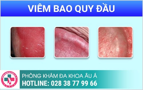 Đau buốt quy đầu