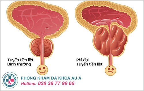 Phì đại tuyến tiền liệt – căn bệnh nguy hiểm chớ xem thường