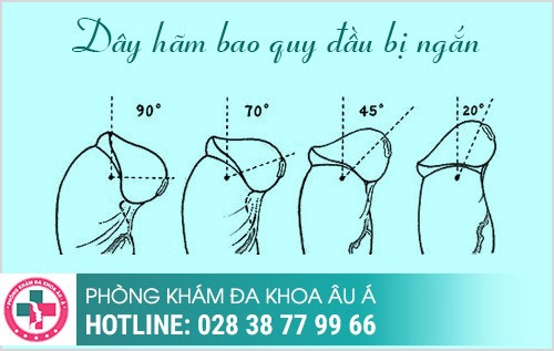Dây hãm bao quy đầu bị đau và cách xử lý