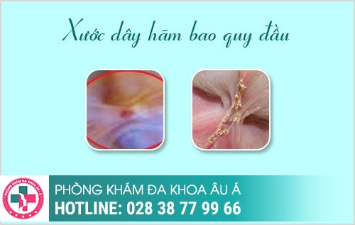 Dây hãm bao quy đầu bị đau và cách xử lý