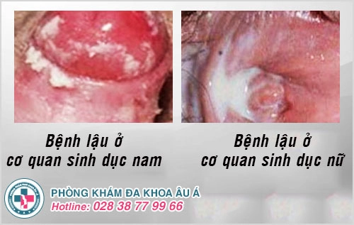 đi giải buốt