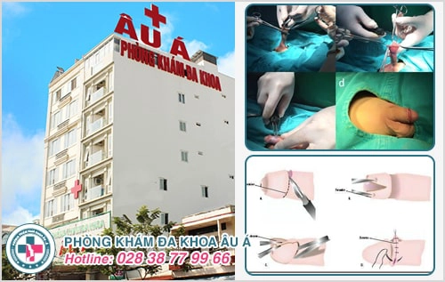 Dính bao quy đầu, bệnh lạ mà quen thuộc