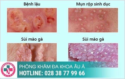 dương vật bị hôi